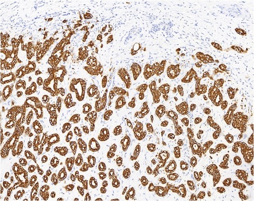 Figure 4 Detection of FGFR2-BICC1 protein in cholangiocarcinoma. Immunohistochemical staining of FGFR2-BICC1 was performed on the surgical biopsy of cholangiocarcinoma.