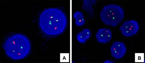 Figure 3 FISH analysis was approached on suspension samples in interphase cells of fresh swelling lymph node specimen using commercial probe (LSI BCR/ABL DS probe, Vysis). (A) Cells with a signal pattern of 1 red, 1 green, and 2 yellow (fusion signal) are positive for BCR/ABL1 rearrangement. (B) Cells with 2 red and 2 green are normal. FISH, Fluorescence in situ hybridization.