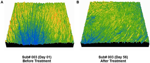 Figure 3 3D Images of Crow’s Feet Area Wrinkles of Subject Number 003 Before and After Consuming Test Treatment. (A) Prevalent blue colour lines indicating the depth of wrinkles on Day 01, before consuming treatment; (B) Reduction in blue colour lines indicating an overall improvement in wrinkles on Day 56, after treatment with Skin Radiance Collagen.