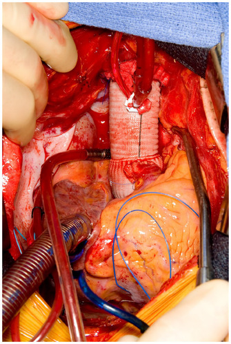 Figure 3 Completed open repair of type A aortic dissection.