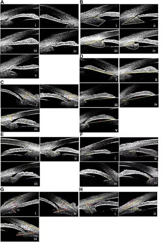 Figure 1 Morphological classifications and types of qualitative parameters revealed on UBM images (A–H). (A) Iris Form (IF) included 5 types, forward bowing of the entire iris (Ai); backward bowing of the entire iris (Aii); flat iris (Aiii); forward bowing of the central iris with backward bowing of the basal iris (Aiv); forward bowing of the basal iris with backward bowing of the central iris (Av). (B) Ciliary body configuration (CBC) included 4 types, parallelogram-like (Bi); cone-like (Bii); mushroom-like (Biii); hook-like (Biv). CBC is a shape surrounded by yellow lines. (C) Basal iris thickness (BIT) included 3 types, < 1/2 corneal limbus thickness (CLT) (Ci); = 1/2 CLT (Cii); > 1/2 CLT (Ciii). The yellow line on iris means the vertical thickness at the peripheral 1/3 of the iris. The short and long yellow lines on the sclera mean the CLT and outer edge of the sclera. The 1/2 of CLT is marked by the red line. (D) Iris convexity (IC) included 4 types, posterior bowing of iris (IC < 0 mm) (Di) or flat iris (IC = 0 mm) (Dii); mild anterior bowing of iris (0 mm < IC ≤ 0.2 mm) (Diii); moderate anterior bowing of iris (0.2 mm < IC ≤ 0.4 mm) (Div); severe anterior bowing of iris (IC > 0.4 mm) (Dv). The yellow line connects the most central part of iris to iris root. The red line is perpendicular between the yellow line and the iris vault. (E) Iris insert (II) included 3 types, base of the ciliary body (Ei); middle part of the ciliary body (Eii); apex of the ciliary body (Eiii). The yellow line shows the remaining position of the anterior surface of the ciliary body after iris insert. (F) Iris angulation (IA) included 4 types, IA = 0° (Fi); 0° < IA ≤ 30° (Fii); 30° < IA ≤ 60° (Fiii); IA > 60° (Fiv). The two yellow lines mean the back surface of the iris and the anterior surface of the ciliary processes. (G) Ciliary body size (CBZ) included 3 types, CBS ≤ 1 CLT (Gi); 1 CLT < CBS ≤ 2 CLT (Gii); CBS > 2 CLT (Giii). The yellow line on the ciliary body connects the midpoint of the ciliary processes to the center of the base of the ciliary body, The red line on the sclera means the corneal limbus thickness. (H) Ciliary body position (CBP) included 2 types, Backward rotation ≥ 45° (Hi); Forward rotation < 45° (Hii). The yellow line on the limbus connects the midpoint of the CLT to the midpoint of the thickness at the mid-peripheral 1/3 of the cornea. The yellow line on the ciliary body connects the midpoint of the ciliary processes to the center of the base of the ciliary body, The angle between the red line and the yellow line on the ciliary body is 45°.