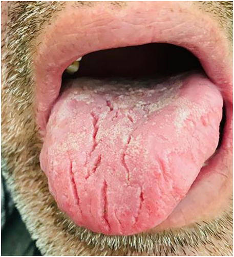 Figure 5 Coated tongue with non-connected fissures.