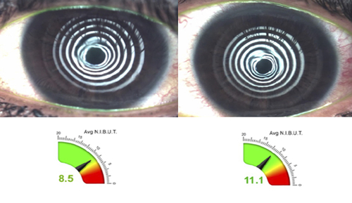 Figure 8 Changes in NITBUT example in a patient treated with subconjunctival injection of sirolimus liposomal formulation. Pre-treatment (left) showing 8.5 seconds and post-treatment (right) 11.1 seconds.