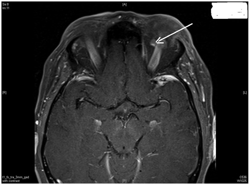 Figure 1. MRI orbits shows an ill-defined hyperdense enhancing nodule in the left intraconal region (arrow).