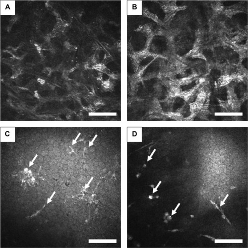 Figure 4 In vivo confocal microscopic images at the level of stroma and endothelium.