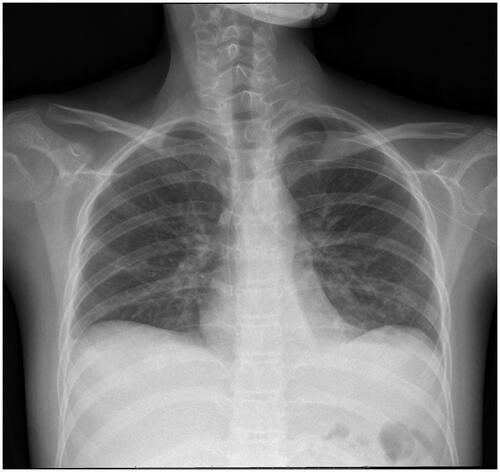 Figure 4. Chest radiograph of case 4.