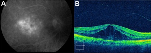 Figure 50 (A) Fluorescein angiography of CME in the recirculation phase of the angiogram demonstrates a classic petaloid leakage pattern of pseudophakic CME. (B) Cirrus™ optical coherence tomography demonstrates cystic macular changes as low-reflective spaces (dark spaces), more prominently at the level of the outer retinal layers.