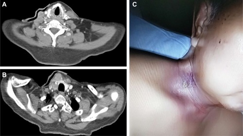 Figure 1 The neck CT scan showed multiple metastatic cervical lymph nodes located in the right III, IV, V, and VI regions, with no clear boundary with the right common carotid artery at the second local regional relapse (A and B). After induction chemotherapy and definitive reirradiation with synchronized weekly chemotherapy, the patient experienced complete remission (C).