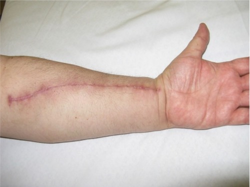 Figure 7 A surgery to remove the radial artery. Furthermore, the fascial tissue is made of contractile fibers, which may possibly produce spasms and consequential dysfunction and pain.