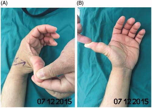 Figure 1. (A,B) A multilocular soft-tissue lipoma on the volar aspect of the left thumb.