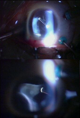 Figure 1 Vitreous shaving with ocular indentation under slit lamp microscope illumination.