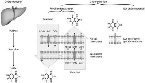 Figure 1. Mechanisms of hyperuricemia. On the left, overproduction of urate through the purine degradation pathway is a minor contributor to serum urate concentrations. Underexcretion of urate is the dominant cause of hyperuricemia in people with gout. In the center, major components of the renal proximal tubule urate transportasome are clustered according to their role as reuptake transporters of urate from filtered urine or as secretory transporters. On the right, in the gut, variants in ABCG2 with reduced function block excretion and contribute to underexcretion. Reproduced with permissionCitation3.