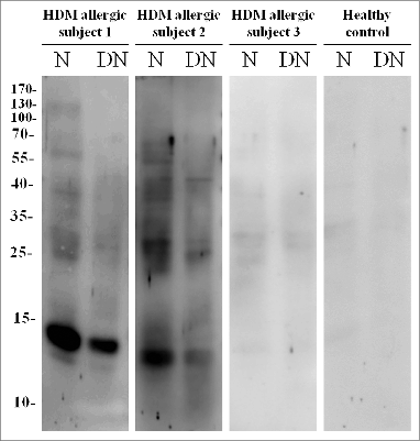 Figure 7. IgE binding capacity of DN-Dp. N: Native Der p crude extract; DN: DN-Dp dialyzed in PBS buffer. Protein extracts were separated on 12% SDS-PAGE. After electrophoresis, protein extracts were transferred to nitrocellulose membranes. Sera derived from HDM allergic subjects and healthy controls were hybridized and signals were detected with nitro-blue tetrazolium and 5-bromo-4-chloro-3'-indolyl phosphate. Levels of HDM specific IgE: subject 1: >100 kU/L; subject 2: 3.97 kU/L; subject 3: 0.50 kU/L.