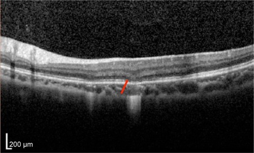 Figure 14 Punctate inner choroidopathy showing disruption of photoreceptor ISel band and ELM (red arrow).