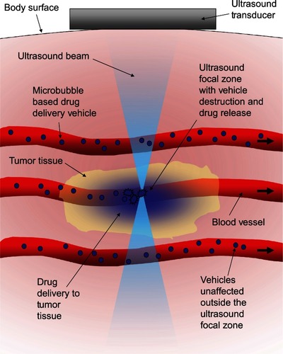 Figure 1 Schematic representation of the concept behind ultrasound-triggered drug delivery.