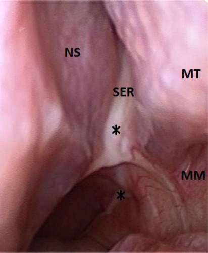 Figure 1 Postnasal discharge from left sphenoethmoidal recess.