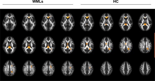 Figure 2 White matter volume difference between WMLs and HC.