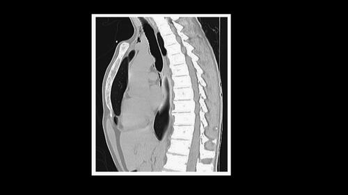 Figure 1. Thoracic computed tomography (CT) (sagittal view) with pneumomediastinum and subcutaneous neck emphysema.