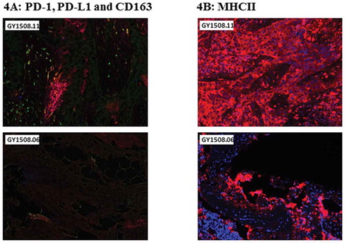 Figure 4. Multiplex immunohistochemistry of tumor samples used for TIL expansion. Images represent tumor slides from selected patients with a high expression/hot (top) and with a low expression/cold (bottom) for each panel. Color schemes of the selected panels were as follows. A, stained for PD-1 (blue), PD-L1 (red) and Cd163 (green). B, stained for MHCII (red) and DAPI (blue).