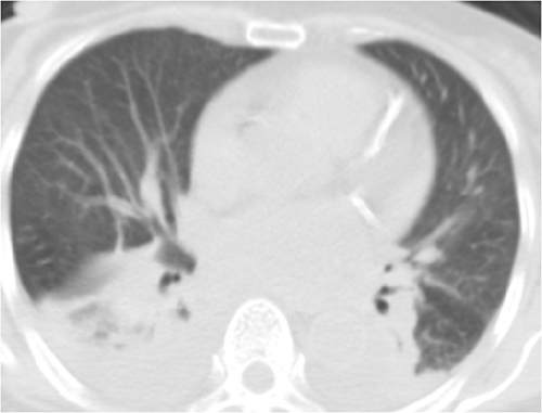 Figure 2 Chest CT scan upon admission for this case. The inflammation and partial consolidation in the bilateral lower lobes of the lungs, along with bilateral pleural effusion.