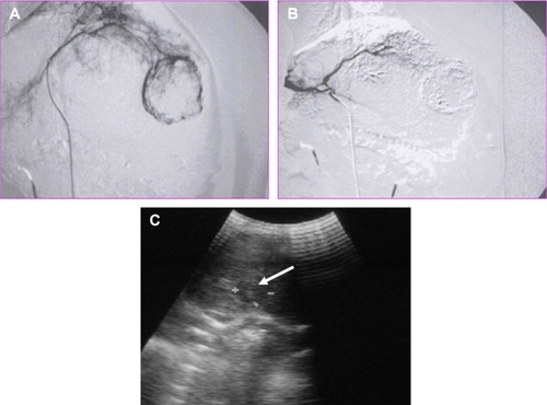Figure 2 DSA and ultrasound images of a VX2 tumor transplanted in a rabbit liver.