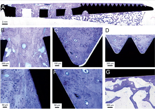 Figure 2. Light microscopic images of the ground section. A. Overview of one side of the implant. B. A closer view of one of the transversal holes in the implant, connecting the outer surface with the hollow inner part. C and D. Many threads were completely filled with mature, Haversian bone. E and F. Closer view of the bone in contact with the implant surface, with multiple osteocytes close to the implant surface. G. The trabecular bone in the hollow center with bone trabeculae reaching to and condensing at the implant surface.