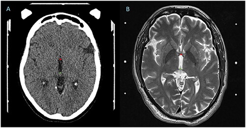 Figure 1. A. example of CT axial slice to demonstrate AC-PC landmarks (red asterisk denotes AC, green asterisk denotes PC); B. example of MR axial slice to demonstrate AC-PC landmarks (red asterisk denotes AC, green asterisk denotes PC).