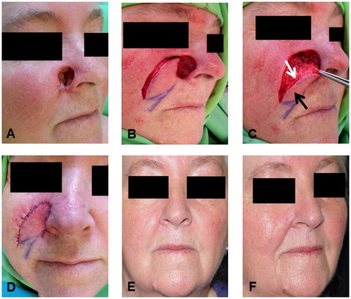 FIGURE 3. Application of the combined flap in a third patient. A: preoperative status, B: dissection of the flap, C: positioning of the flap, white arrow: the subcutaneous part of the flap via which perforators enter the flap, black arrow: direction of the cutaneous branches from the medial part of the flap, D: early postoperative status, E and F: late postoperative status.