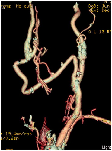 Figure 2. Computed tomography virtualization of the carotid–carotid bypass [Citation6].