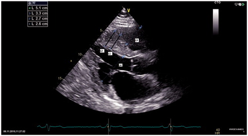 Figure 2. Two dimensional echocardiography in a patient with HCM. Interventricular septum is thickened, about 2.6–2.7 cm (bars L1 and L2), shown in bold black in the figure) and granular. RV and LV end-diastolic dimensions are normal (bars L3 and L4).