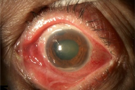 Figure 4 Photograph of left eye of 72-year-old female with BAE from Moraxella sp. Presenting VA: 1/200, IOP: 35 mmHg. Treatment: tap and injection. Final VA: 20/25, IOP: 11 mmHg. Moraxella cases were associated with a better presenting view of the fundus and better VA outcomes than Pseudomonas and Serratia cases.