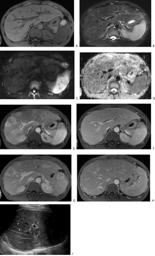 Figure 3 A 41-year-old man with AIDS-related hepatic Kaposi’s sarcoma. Plain scan MRI shows multiple nodular lesions in the liver, with low signal on T1 weighted imaging (A), high signal on T2 weighted imaging (B), slightly high signal on diffusion weighted imaging (C), and high signal on apparent diffusion coefficient map (D). Enhanced scanning of the arterial phase (E) showed circular enhancement, located adjacent to the portal vein and under the hepatic capsule. The portal vein phase (F) shows gradual enhancement of nodules with equal to slightly lower enhancement. Delayed phase imaging (G) showed high and equal enhancement of the nodules, as well as intrahepatic bile duct dilation and thickening of the bile duct wall (H). Ultrasound (I) showed multiple hyperechoic nodules (arrows) distributed along the portal vein in the liver, with thickening of the Glisson sheath and enhanced echogenicity (arrowhead).