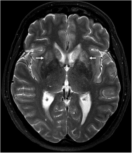 Figure 2. Cranial magnetic resonance imaging of case 1. The typical affection of the basal ganglia (arrows) as found in acute BoDV-1 encephalitis [Citation10] is shown in this case of a probable BoDV-1 encephalitis according to the case definition criteria [Citation7]. Transversal T2-weighted image.