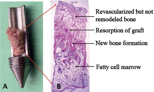 Figure 1. A. The bone conduction chamber with a freeze-dried graft. The graft is placed in the chamber and mesenchymal tissue grows in from the bottom upwards into the bone graft, which subsequently remodels. B. Histological picture (hematoxylin and eosin, ×20) of an untreated graft after 6 weeks in the chamber. Ingrowth occurs from the bottom of the picture as the graft is revascularized. Bone formation lags behind the vascular ingrowth and starts with an osteoclastic resorption of the bone graft, followed by a front of new forming bone. In this unloaded model, the new bone is almost entirely resorbed and finally remodeled into a fatty cell marrow.