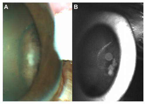 Figure 1 Slit-lamp findings demonstrate keratic precipitates in the left eye, 1+ nuclear sclerotic cataract, and a ciliary body lesion.