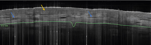 Figure 4 OCT image of pruritic, normal looking skin in an intrinsic atopic dermatitis patient. Horizontal dermal vessels enlargement and density increase (blue arrows); slight demarcation of dermal-epidermal junction as subtle darker band (Orange arrow).