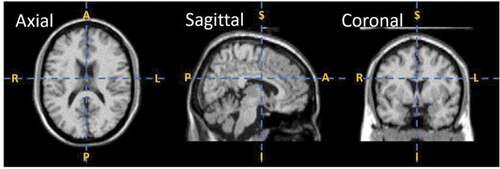 Figure 1. MRI scan in different cross-sectional views, where A, P, S, I, R, and L in the figure represent anterior, posterior, superior, inferior, right, left, respectively. The axial/horizontal view divides the MRI scan into head and tail/superior and inferior portions, sagittal view breaks the scan into left and right and coronal/vertical view divides the MRI scan into anterior and posterior portions (Schnitzlein and Murtagh Citation1985).