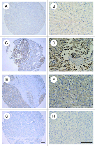 Figure 1. overexpression of ATF4 in HCC tissues. Hepatocellular carcinoma (HCC) and normal liver tissues were analyzed for ATF4 expression by immunostaining. (A and B) normal liver tissues. (C–E), hepatocellular carcinoma tissues. (C and D) The expression of ATF4 is evident. (E and F) The expression of ATF4 is moderate. (G and H) The expression of ATF4 is negative. Representative pictures for HCC and normal tissues are shown. Scale bar equals 100 μm.