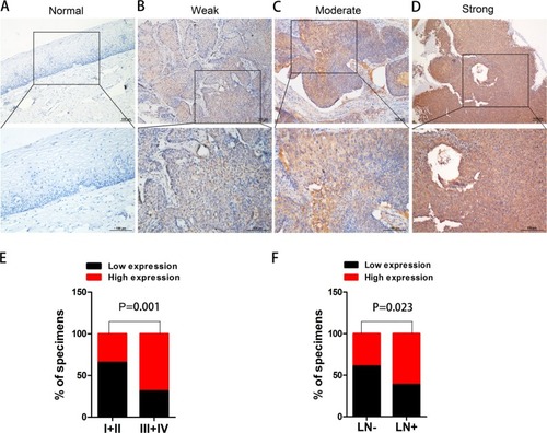 Figure 2 Immunostaining of PKM2 in normal cervical epithelial tissue and CC tissues.Notes: (A) Negative expression of PKM2 in normal cervical epithelial tissues. (B) Weak expression, (C) moderate expression, (D) strong expression of PKM2 in CC tissues, and (E, F) the relationships between PKM2 expression and the clinicopathologically significant aspects of CC.Abbreviations: CC, cervical cancer; PKM2, pyruvate kinase isozyme type M2.