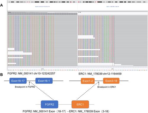 Figure 3 Next-generation sequencing analysis showed an FGFR2-ERC1 fusion mutation following blood analysis and lung tissue biopsy. (A) Integrative Genomics Viewer snapshot of the FGFR2-ERC1 fusion; (B) a schematic map of the FGFR2-ERC1 fusion protein domain structure.