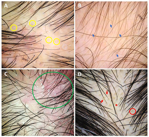 Figure 1 Trichoscopic features of syphilitic alopecia (original magnification x20): (A) empty follicles (yellow circles) and erythematous background; (B) hypopigmented hair shafts (blue arrows) and erythematous background; (C) perifollicular scales, interfollicular scales, and erythematous background (green circle); (D) tapered hairs (red arrows), black dots (red star), and yellow dots (red circle).