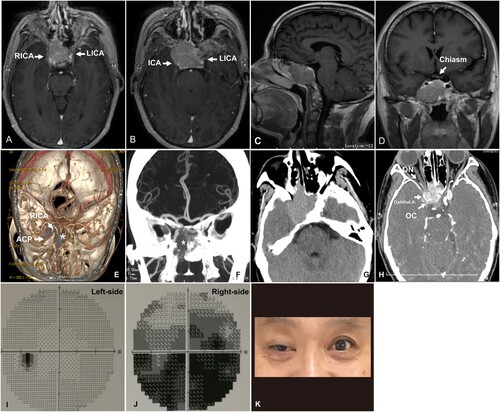 Figure 1. Preoperative MRI T1 with contrast, CTA, and ophthalmic examination. Enhanced Axial (A, B), sagittal (C), and coronal (D) MRI showed a sellar pituitary mass with sphenoidal extension and invasion. The right ICA was compressed and shifted posteriorly. The optic chiasm was not affected. 3D reconstruction (E), coronal (F), coronal with and without (G) contrast showed that the main portion of the tumor (*) was located in the sphenoidal sinus. The right ICA and the optic canal were involved (H). (I, J) The test revealed a severe visual field defect on the right side and a slight defect on the left side. (K) The patient presented a symptom with CN III palsy.