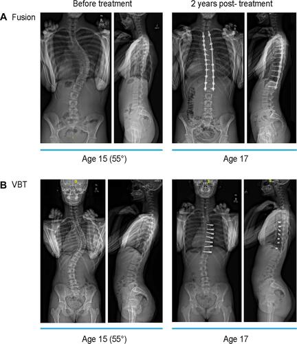 Figure 1 Examples of pediatric patients with idiopathic scoliosis before and 2-years after surgical intervention with (A) spinal fusion or (B) VBT. (A) 15-year-old patient with 55° right thoracic curve treated with spinal fusion at 2 years postoperative follow-up. (B) 15-year-old patient with 55° right thoracic curve treated with anterior vertebral body tethering at 2 years postoperative follow-up.