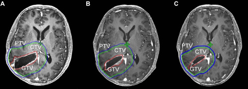 Figure 1 Target volumes on MRI1, MRI2 and MRI3 are displayed in (A–C), respectively. The GTV, CTV and PTV are shown as red, green and blue solid lines, respectively.