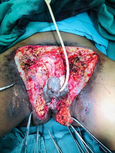 Figure 4 Partial vulvectomy surgery to treat hidradenitis suppurative.