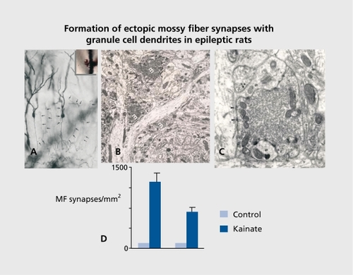 Figure 2. Electron microscopic identification of aberrant mossy fiber terminals on granule cells weeks after an inaugurating status. Note the formation of synapses in regions that are not innervated by mossy fibers in controls. These aberrant synapses have all the typical unique features of mossy fiber terminals, notably the large size and the enrichment in vesicles. D: Left and right columns show the upper and lower blades of the granular cell layer. Reproduced from ref 45: Represa A, Pollard H, Moreau J, Ghilini G, Khrestchatisky M, Ben-Ari Y. Mossy fiber sprouting in epileptic rats is associated with a transient increased expression of alpha-tubulin. Neurosci Lett. 1993;156:149-152. Copyright © Elsevier Scientific Publishers ireland 1993