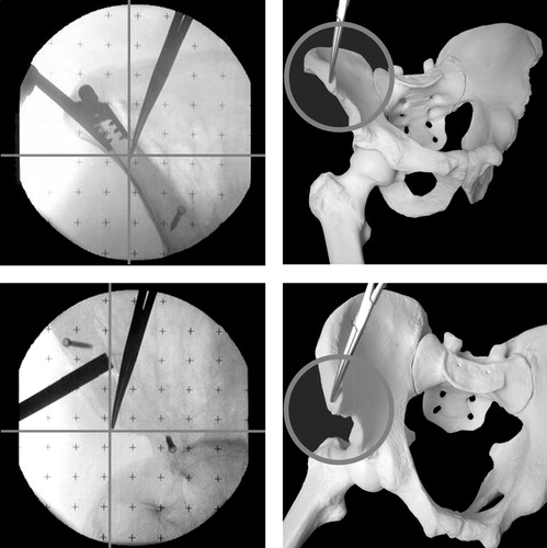 Figure 2. The two fluoroscopic views used to define the anterior superior iliac spines. A frontal view allows definition of the midpoint between the visceral and parietal compacta. A lateral view reveals the most prominent point of the spine.