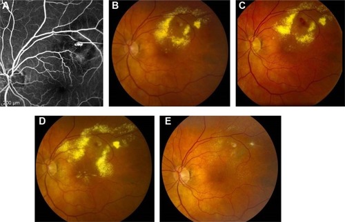 Figure 1 Fluorescein angiography and fundus photographs.