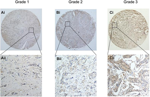 Figure 3 Representative immunohistochemical images of CLIC1 expression in BC tissues and adjacent normal tissues.