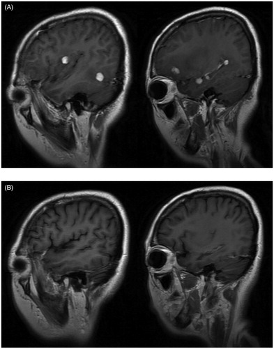 Figure 1. (A) Sagittal T1 magnetic resonance imaging showing multiple nodular enhancement lesions in the brain. (B) Intracranial lesions became apparently smaller and surrounding edema was less obvious after four-course of cytarabine.